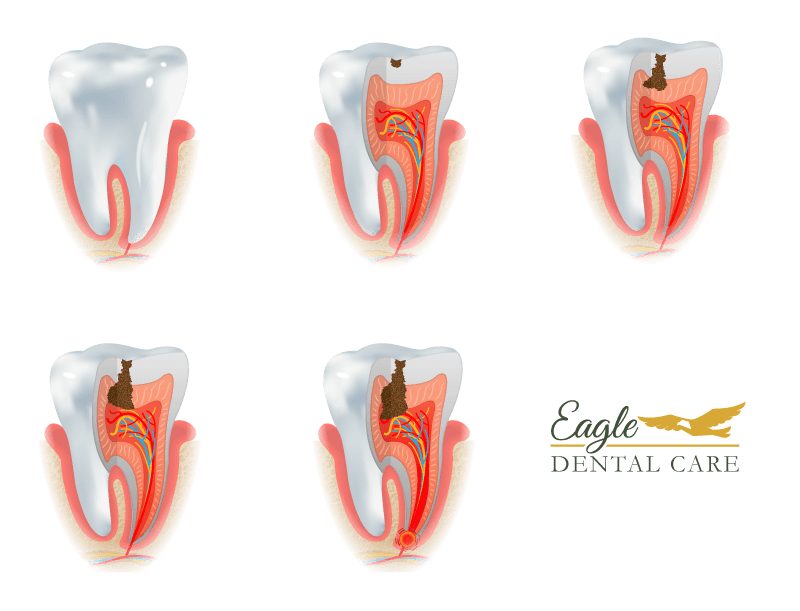 Stages of cavity formation eventually reaching the root of the tooth.